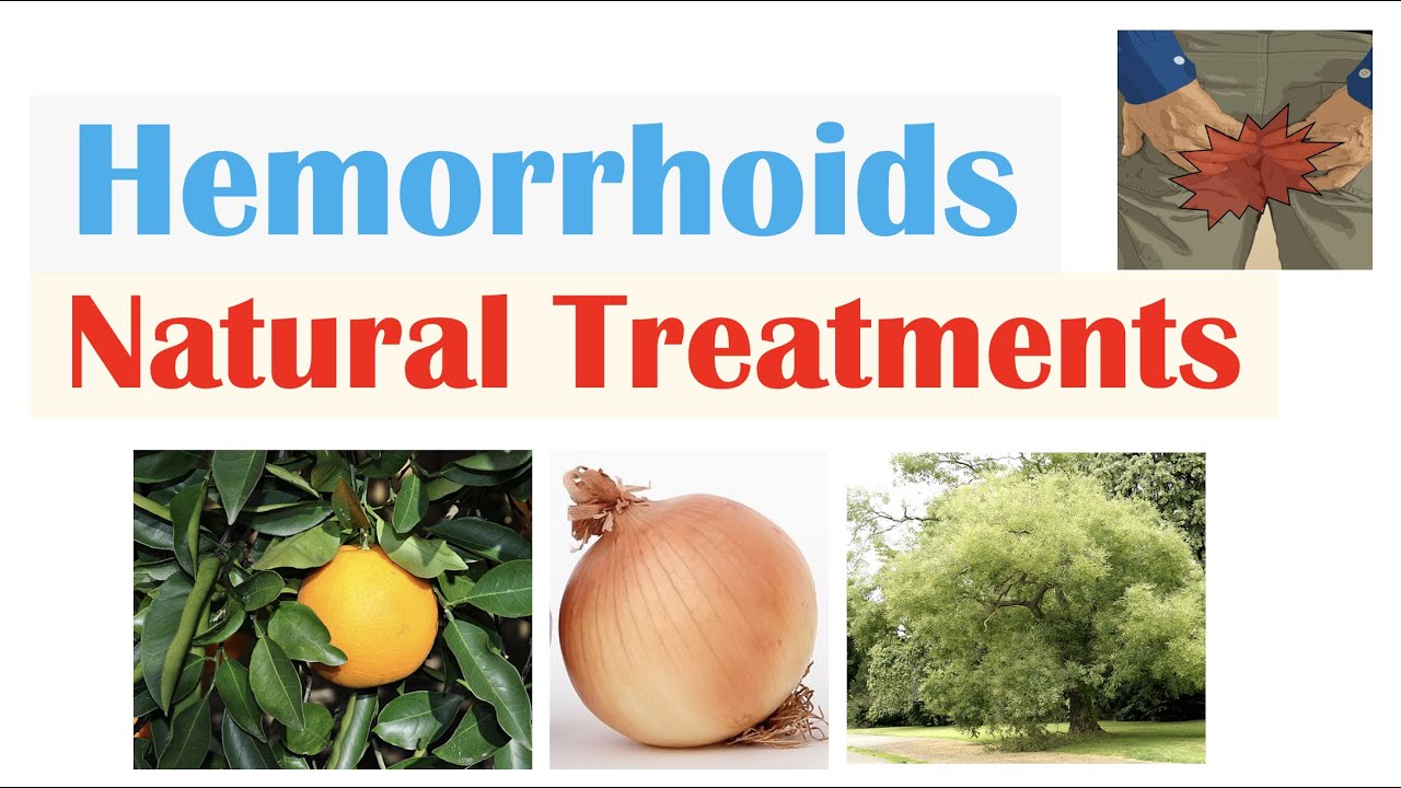How To Treat Hemorrhoids | 9 Natural Treatments (Plant Flavonoids) for Hemorrhoidal Disease