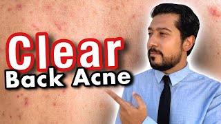 Back Acne | How to Get Rid of Back Acne FAST