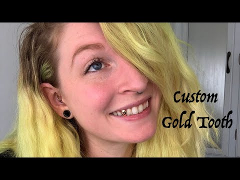 Getting a Custom Gold Tooth Cap