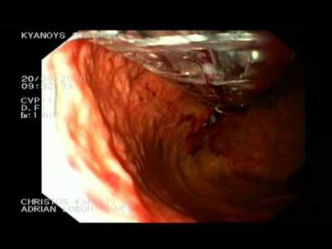 Esophyx - funduplicatura endoscópica, parte 3