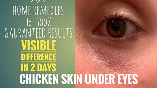 Chicken Skin Under Eyes | Natural Home Remedies with 100% results.