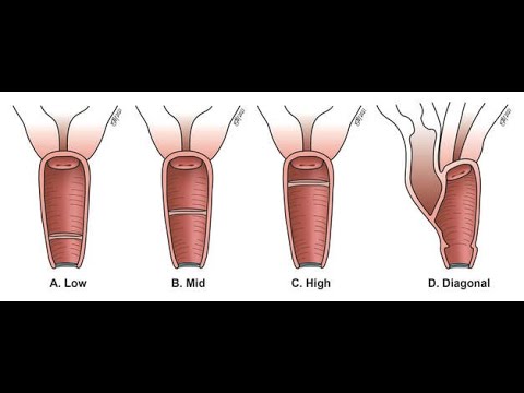 hymenal anomalies;  Imperforate Hymen, Microperforate Hymen, Septate Hymen