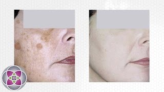 Laser Age Spot Removal Treatment