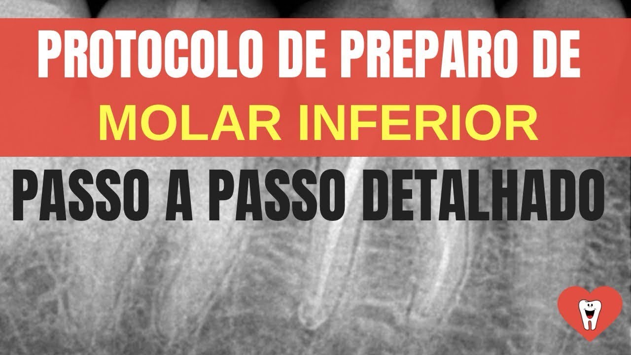 ENDODONTIA PASSO A PASSO - MOLAR INFERIOR - Endolovers