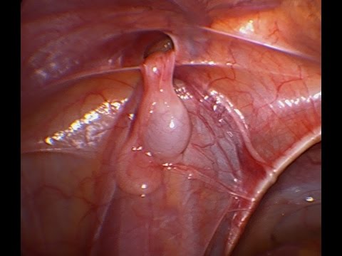 Laparoscopic Orchiopexy in Undescended Testis