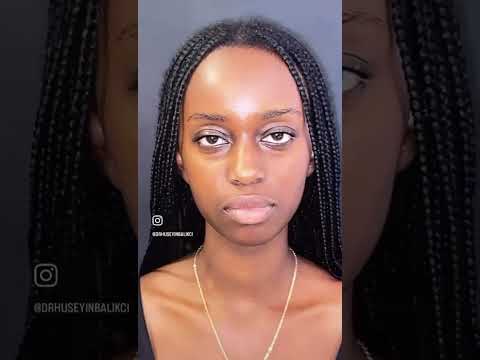 Ethnic Afro Rhinoplasty in Antalya with Dr. Hüseyin Balıkçı