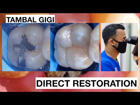 Replacing Amalgam to Natural Composite Bonding Restoration