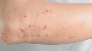 how to get rid of hives on your body fast