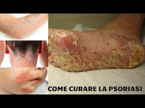 La dieta pegano a psoriasi che è possibile Ayevit da psoriasi di unghie