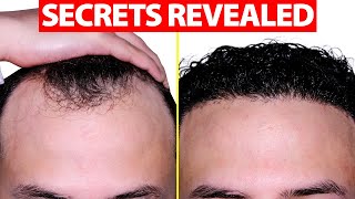 How to Fix Your Receding Hairline