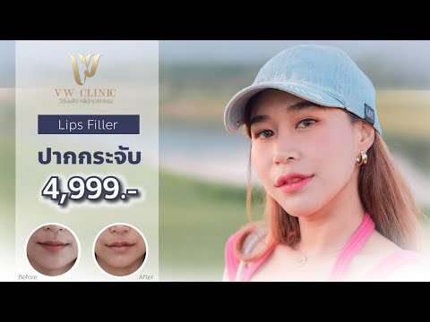 Filler ปากกระจับ
