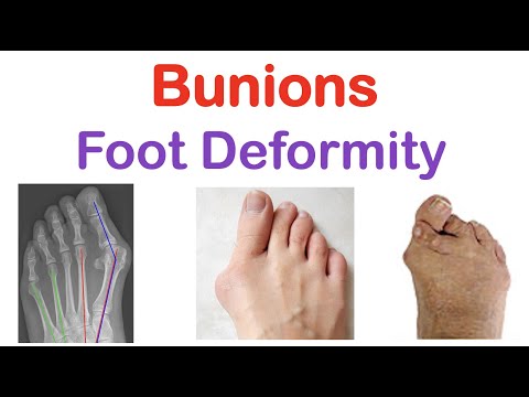 Bunions Foot Deformity Types Bunionettes Risk Factors Symptoms Diagnosis Treatment