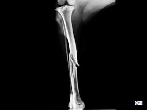 BLUE. Fractura de tibia