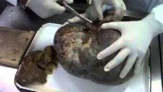 tumor de ovario