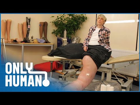 Mandy Sellars: Shrinking My 17 Stone Legs | Extraordinary People | Only Human