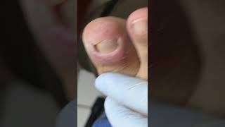 Ep_8474 Big ingrown toenail removal 👣 พี่บอกแล้ว..แป๊บเดียว 😄 (clip from Thailand)