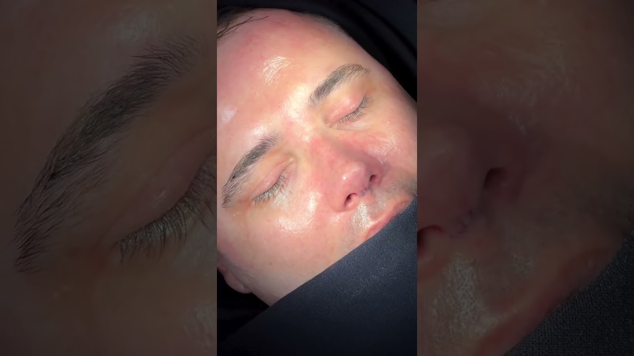 Burun Estetiği - Rinoplasti - Video 9