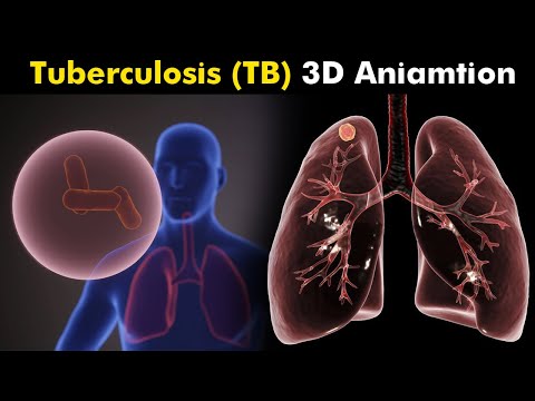 What Happens in Tuberculosis (TB)? | 3D Animation | Types, Causes, Symptoms, Treatment (Urdu/Hindi)