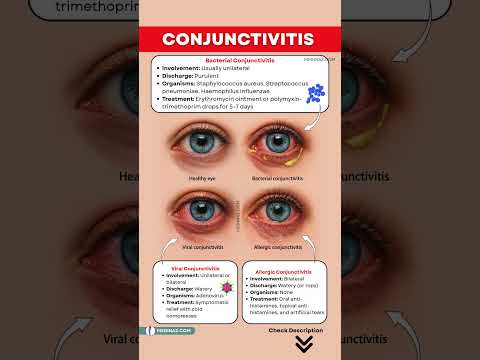 Conjunctivitis - Viral, Bacterial and Allergic – Symptoms, Causes & Treatment | Pink Eyes