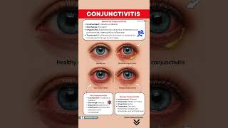 Conjunctivitis - Viral, Bacterial and Allergic – Symptoms, Causes & Treatment | Pink Eyes