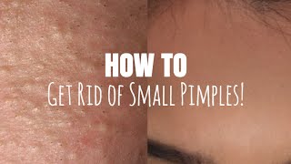 How to Get Rid of Small Pimples! (Accutane free)