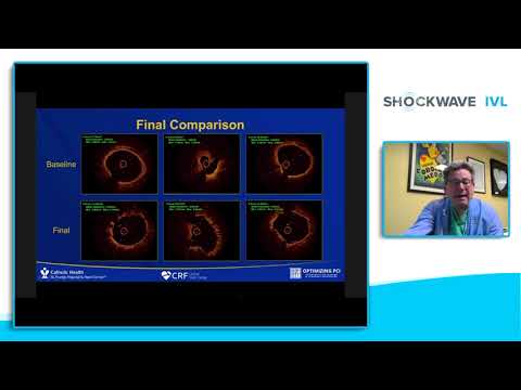 Coronary IVL’s Who, What, Where, When & Why: An Introductory Guide for Clinical Practice at ACC.21