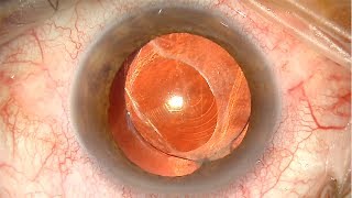 Recambio de lente intraocular multifocal. Centro de Oftalmología Bonafonte. Barcelona.