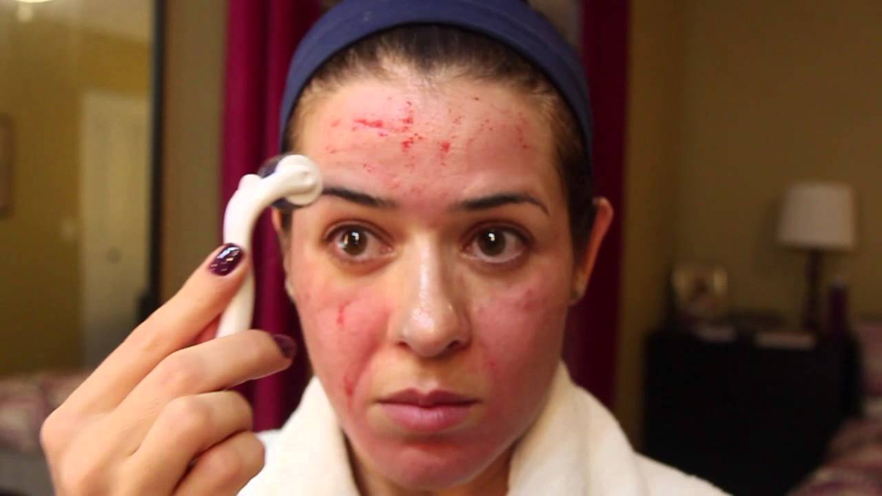 Rejuvenesça 10 anos sem gastar muito! Microagulhamento - Dermaroller parte 2