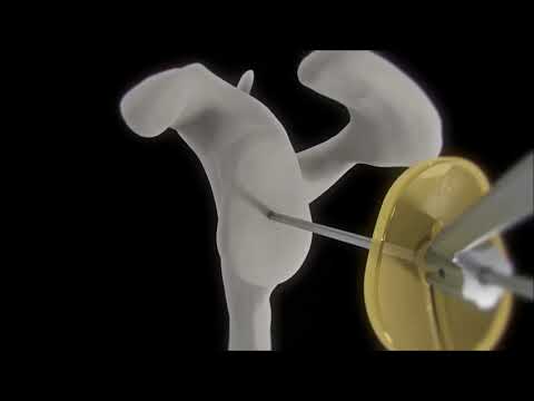 AltiVate Anatomic Surgical Technique Animation