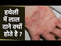 हथेली में लाल दाने होने का कारण Hatheli Me Laal Da