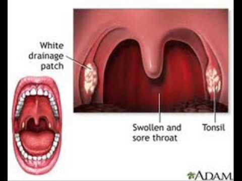 Halamang-singaw sa iyong mga paa kailangan mo ng ilang ointment Levomekol sa paggamot ng ingrown toenail