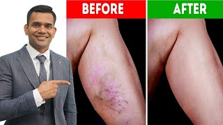 Get Rid Of Varicose vein, Burning Sensation in Feets and cold Feets
