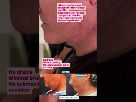Deep Plane Facelift + Deep Neck Lift | 14 Hours Before & After Recovery
