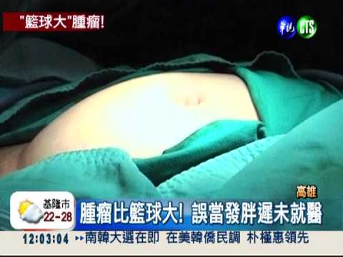 卵巢藏籃球大腫瘤 女子誤當發胖!