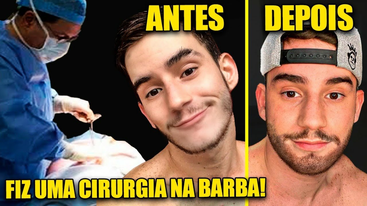FIZ IMPLANTE DE BARBA: Deu ruim Doeu Preço Como ficou 😱😱👀 | Klébio Damas