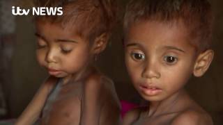 Fragile children's bodies reflect reality of Yemen crisis