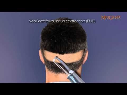 NeoGraft Animated Hair Restoration Video - See how Surgery can Restore Your Hair