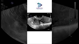 Unruptured right ectopic tubal gestation#damayanthi#chandana