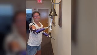 Bend woman’s powerful recovery after losing hands and feet to infection