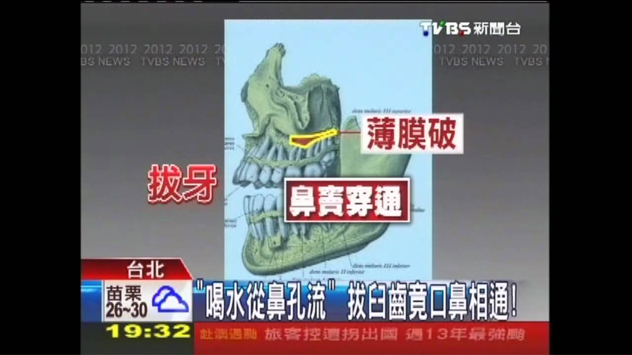 「喝水從鼻孔流」 拔臼齒竟口鼻相通!