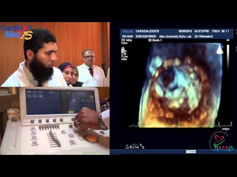 How to perform 3D-TTE exam "a step by step approach"