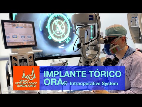 IMPLANTE DE LENTE TORICO con el ORA System. Precisión refractiva.
