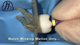 How to Achieve Patency during Root Canal Treatment using One Manual File? | Double Curvature Canal..