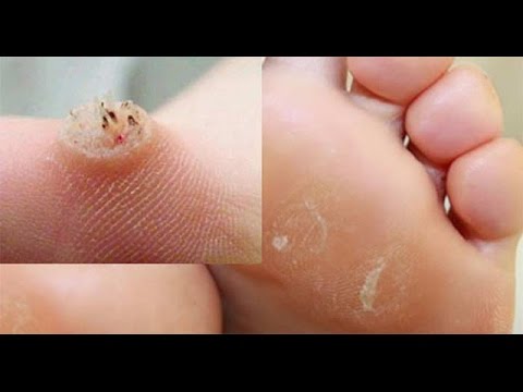 Asd2 แผนกต้อนรับส่วนหน้าในโรคสะเก็ดเงิน กลาก Radevit ช่วย