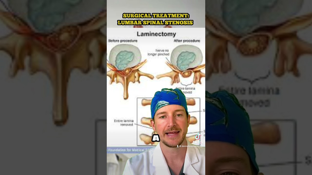 Spinal Stenosis: SURGERY (explained at a 5th grade level) 🤓🤔