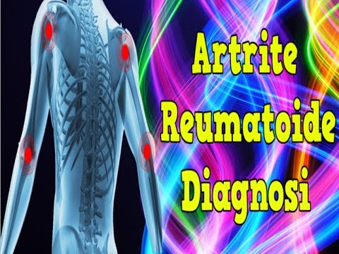 Trattamento unguento della lombalgia Artrosi deformante delle articolazioni dellanca di 1-2 gradi