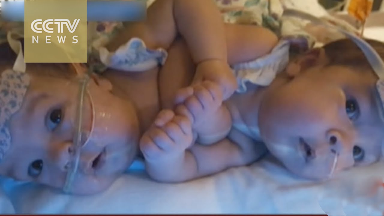 Conjoined twins separated using 3D printing