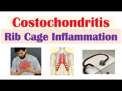 Costochondritis (Rib Cage Inflammation) | Causes, Symptoms, Diagnosis, Treatment