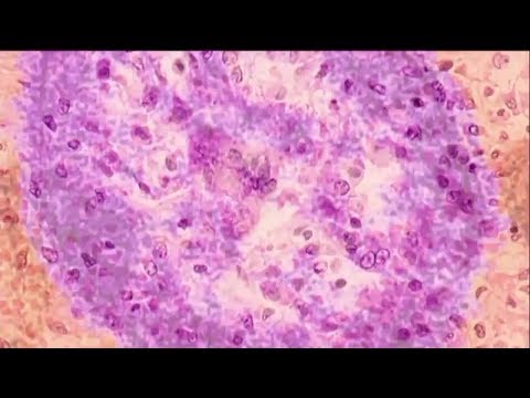 Measles Cases Growing