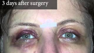 Upper Eyelid Surgery - After Photos 3 Days Post Surgery | 8 West Clinic in Vancouver, BC